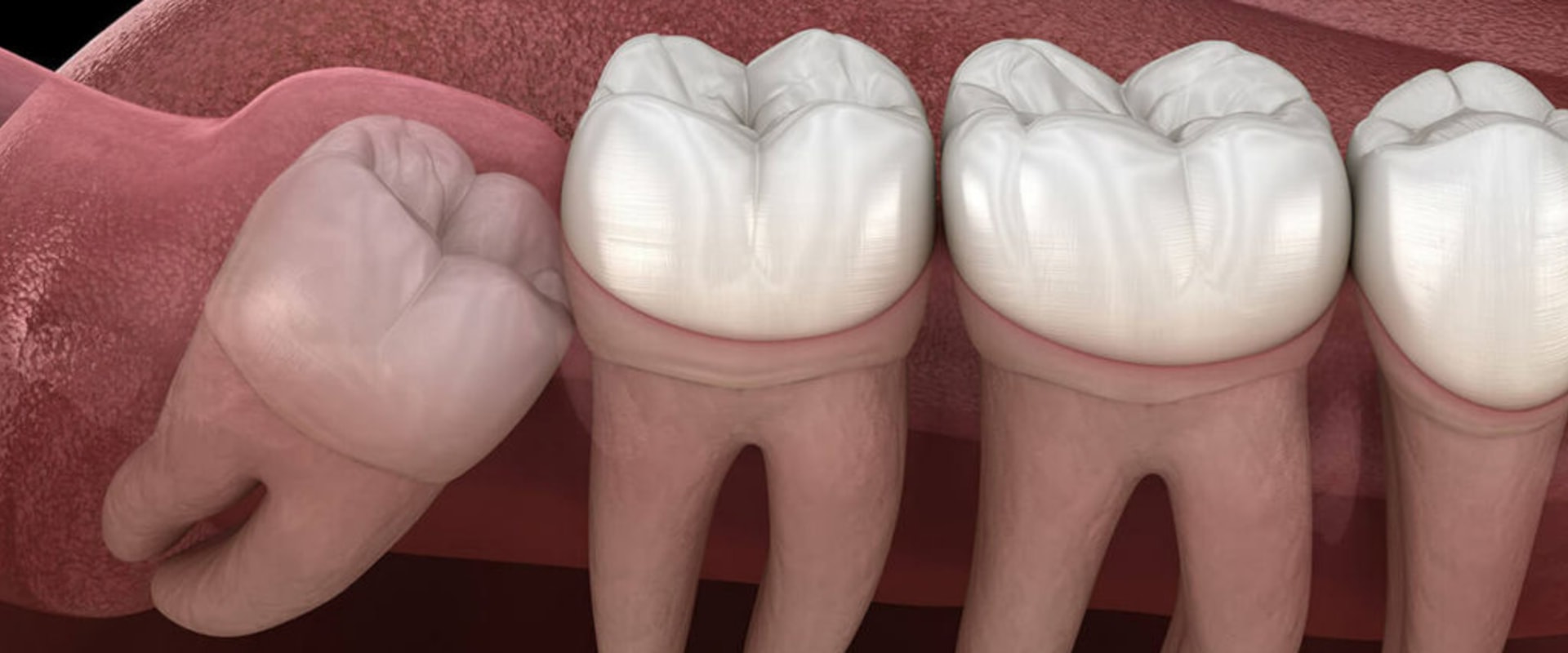 Do Kern Family Health Care Plans Cover Wisdom Teeth Removal?