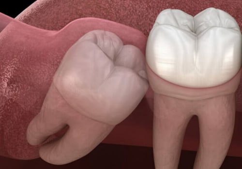 Do Kern Family Health Care Plans Cover Wisdom Teeth Removal?