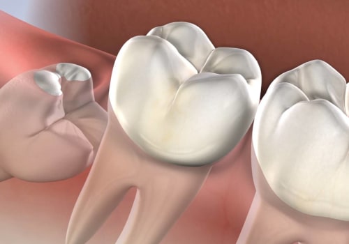 Who Pays for Wisdom Teeth Removal? An Expert's Guide